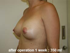 plastic-surgery-breast-augmentation