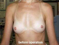 plastic-surgery-breast-augmentation