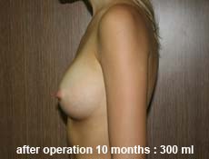 plastic-surgery-breast-augmentation