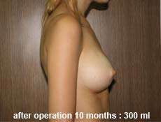 plastic-surgery-breast-augmentation