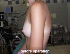 plastic-surgery-breast-augmentation