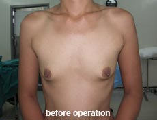 plastic-surgery-breast-augmentation