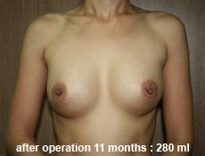 plastic-surgery-breast-augmentation