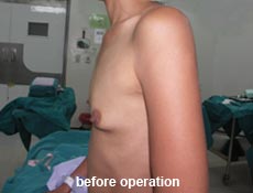 plastic-surgery-breast-augmentation