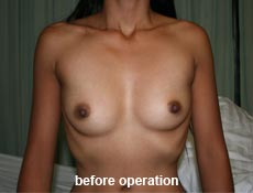 plastic-surgery-breast-augmentation