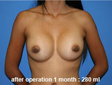 plastic-surgery-breast-augmentation