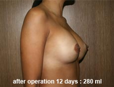 plastic-surgery-breast-augmentation