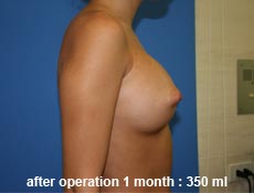 plastic-surgery-breast-augmentation