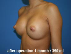 plastic-surgery-breast-augmentation