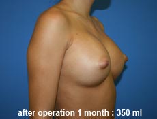 plastic-surgery-breast-augmentation