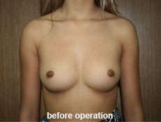 plastic-surgery-breast-augmentation