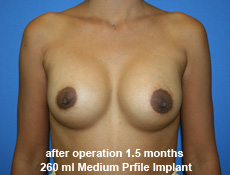 plastic-surgery-breast-augmentation