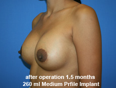 plastic-surgery-breast-augmentation