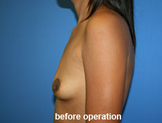 plastic-surgery-breast-augmentation