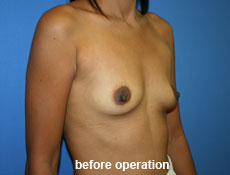 plastic-surgery-breast-augmentation