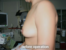 plastic-surgery-breast-augmentation