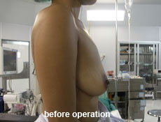 plastic-surgery-breast-augmentation