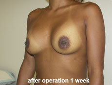 plastic-surgery-breast-augmentation
