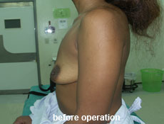 plastic-surgery-breast-augmentation