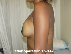 plastic-surgery-breast-augmentation