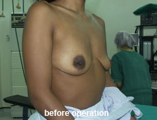 plastic-surgery-breast-augmentation