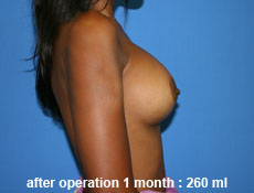 plastic-surgery-breast-augmentation
