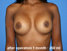 plastic-surgery-breast-augmentation