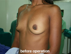 plastic-surgery-breast-augmentation