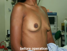 plastic-surgery-breast-augmentation