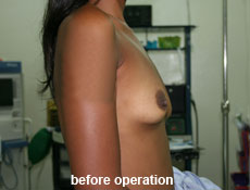 plastic-surgery-breast-augmentation