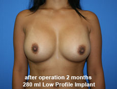 plastic-surgery-breast-augmentation
