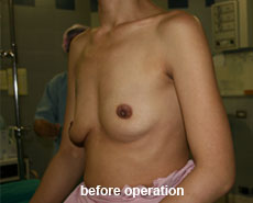 plastic-surgery-breast-augmentation