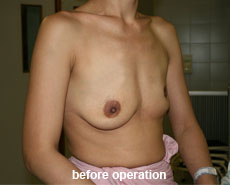 plastic-surgery-breast-augmentation