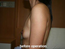plastic-surgery-breast-augmentation