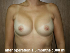 plastic-surgery-breast-augmentation