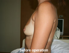 plastic-surgery-breast-augmentation