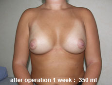plastic-surgery-breast-augmentation