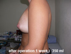plastic-surgery-breast-augmentation