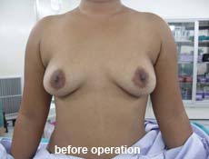 plastic-surgery-breast-augmentation