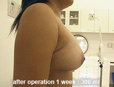plastic-surgery-breast-augmentation