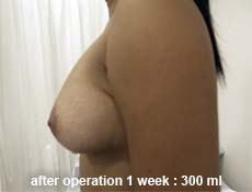 plastic-surgery-breast-augmentation
