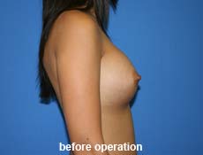 plastic-surgery-breast-augmentation 