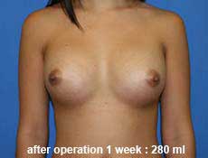 plastic-surgery-breast-augmentation 