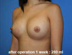 plastic-surgery-breast-augmentation 