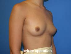 plastic-surgery-breast-augmentation 