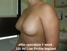 plastic-surgery-breast-augmentation