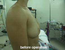 plastic-surgery-breast-augmentation