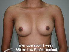 plastic-surgery-breast-augmentation