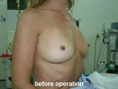 plastic-surgery-breast-augmentation
