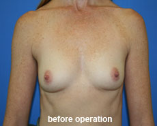plastic-surgery-breast-augmentation